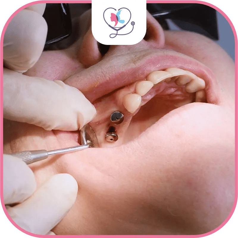 Quels sont les différents types d’implants dentaires ?