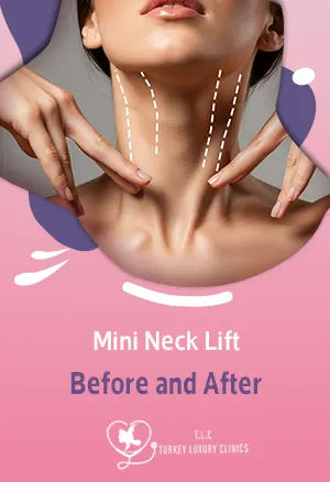 Mini Neck Lift Before and After: Smooth & Natural Transformation 
