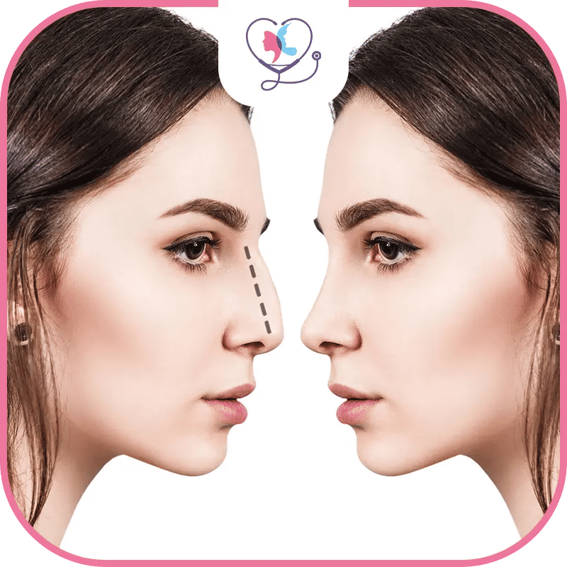 الاستعداد لجراحة تجميل الانف