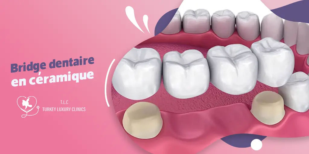 Bridge dentaire en céramique : esthétique et durabilité