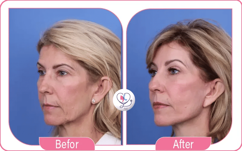 Blépharoplastie avant après risques