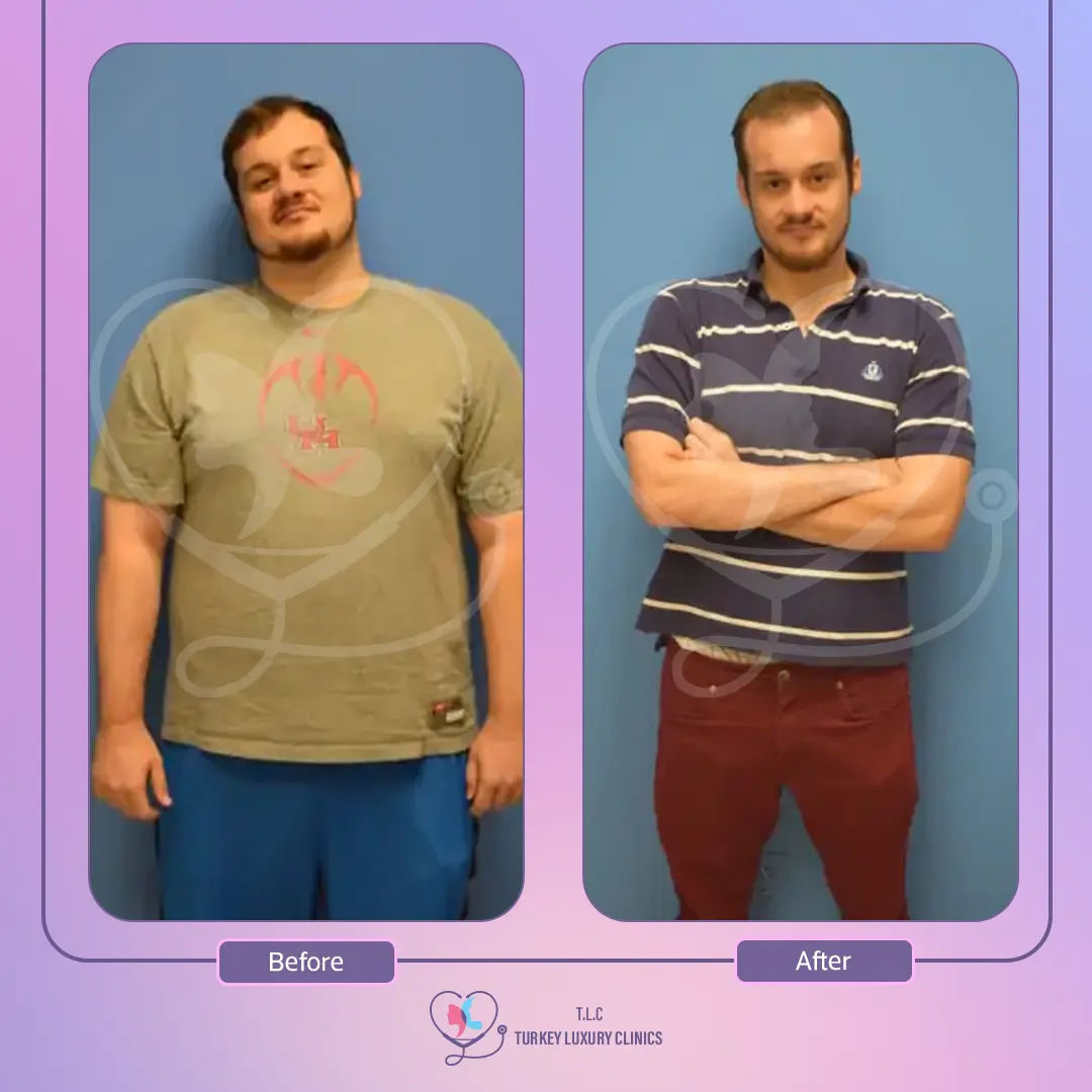 مزايا إجراء تكميم المعدة في تركيا لاكشري كلينك