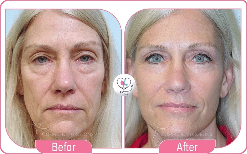 Localisation des Cicatrices après Mini Lifting du Visage-4