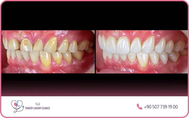 Zirconium crowns before and after photos Turkey – dramatic smile transformation with zirconia dental crowns Istanbul