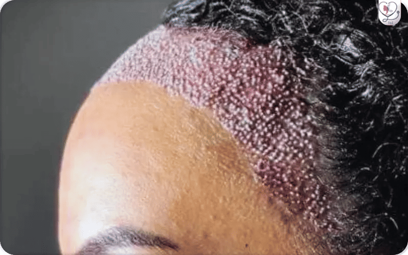 أضرار الخلايا الجذعية للشعر أضرار الخلايا الجذعية للشعر