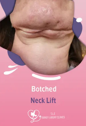 Botched Neck Lift: Signs Your Neck Lift Went Wrong