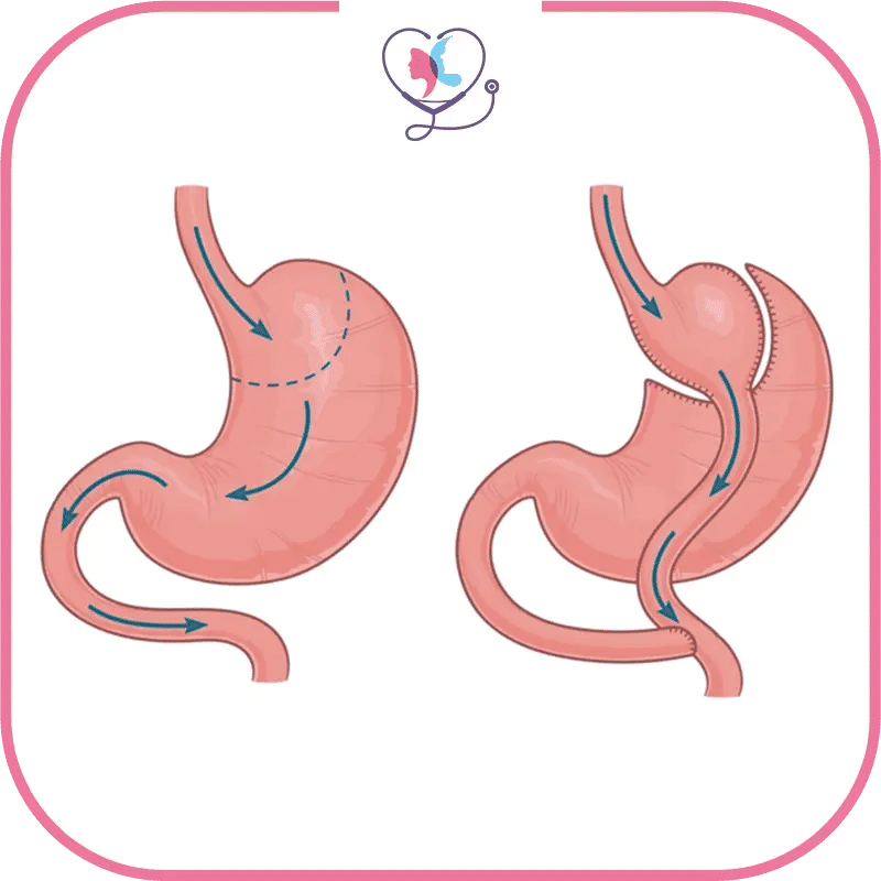 Qu'est-ce que le bypass gastrique ? Comment fonctionne-t-il ?