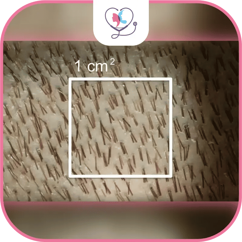 Can a second hair transplant improve hair density?