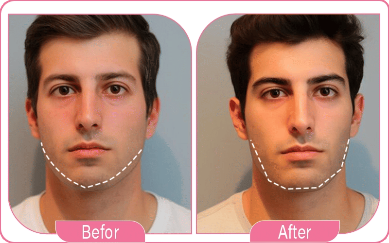 lifting sans chirurgie avant après