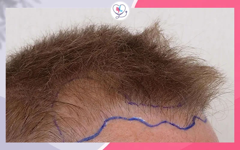 نمو الشعر المزروع باتجاه غير طبيعي