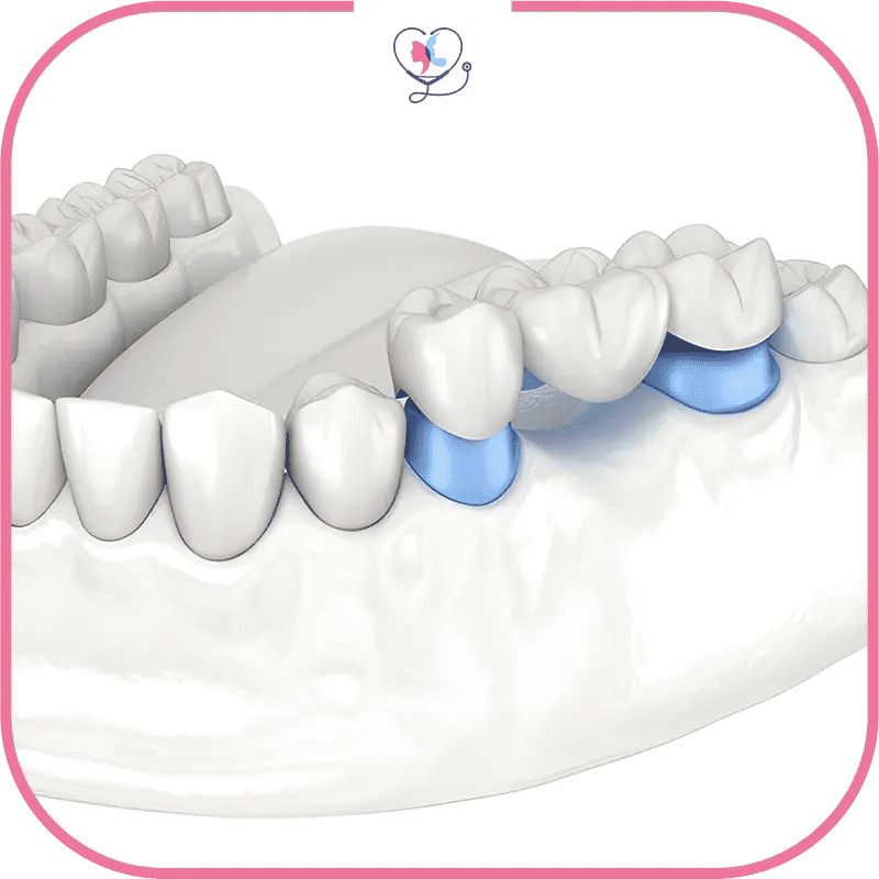 durée de vie d'un bridge dentaire