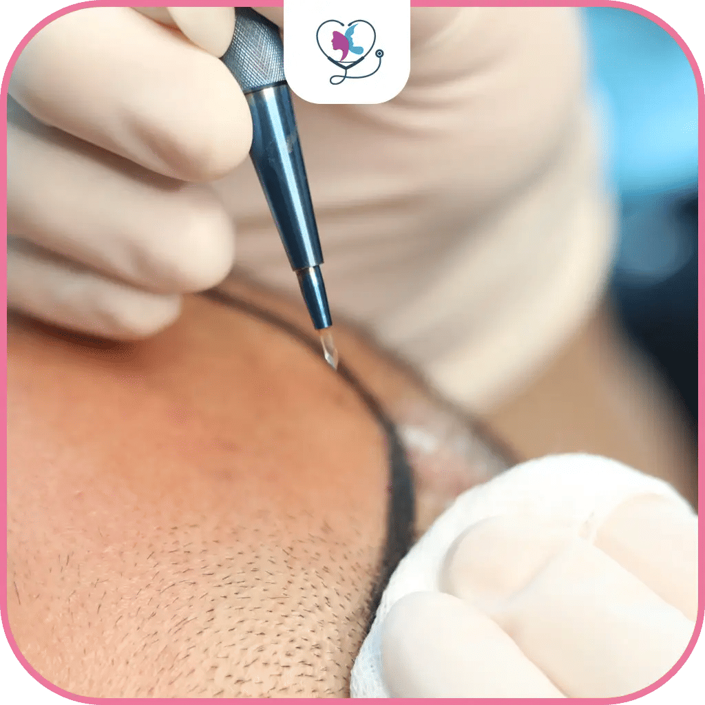 زراعة الشعر للرجال في تركيا