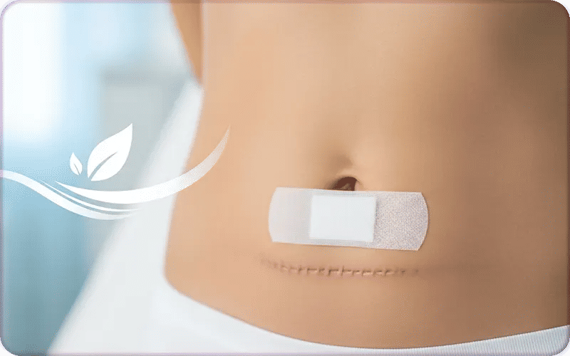 Quels risques pour l’abdominoplastie ?