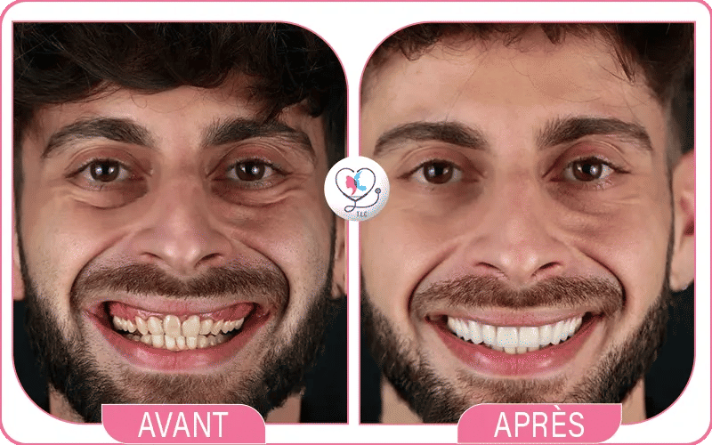 تجربتي مع ازالة جير الأسنان