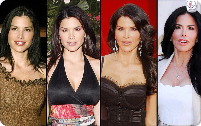 Celebrity Lauren Sánchez with visible changes from reported plastic surgery.