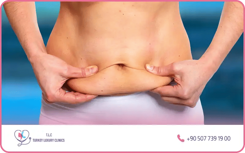 ما هي عملية شد البطن بعد الولادة القيصرية؟