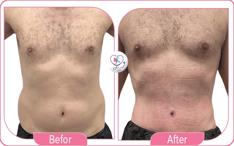 تقنيات شفط الدهون المستخدمة