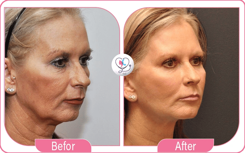 lipofilling visage avant et après-3