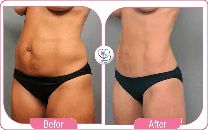 شفط دهون الفخذين قبل وبعد