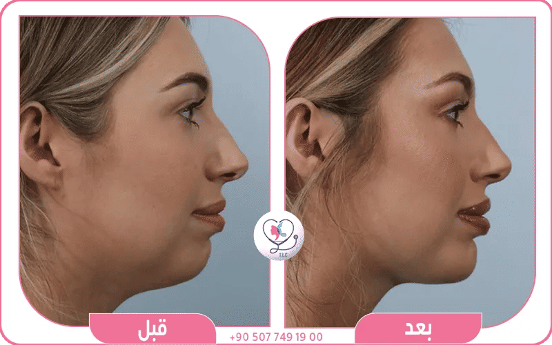 ما هي عملية الذقن؟