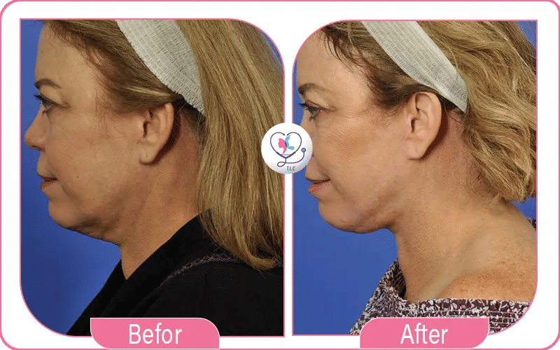 Mini Neck Lift Before and After Pictures
