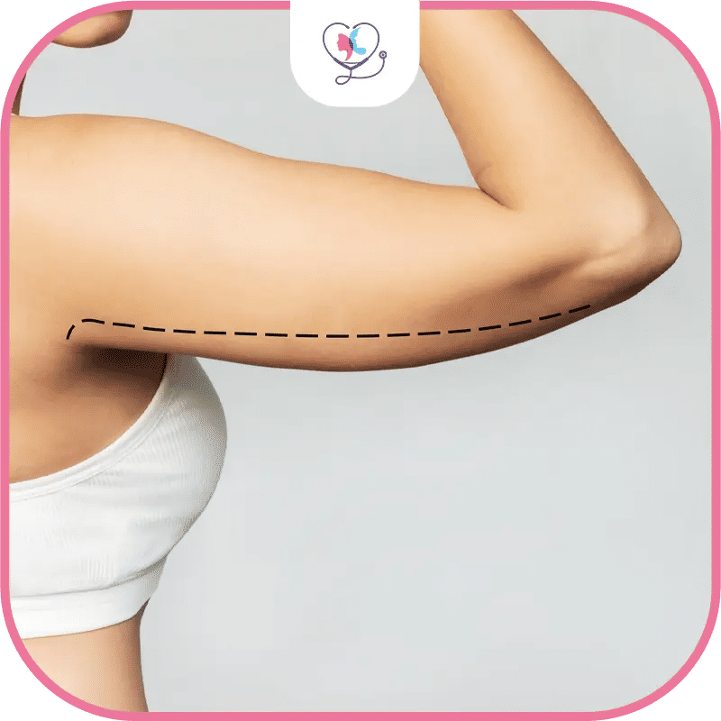 من هم المرشحون لعملية شفط دهون الذراعين؟