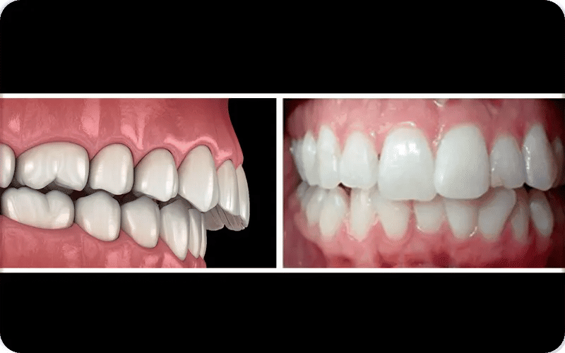 What is an Overbite?