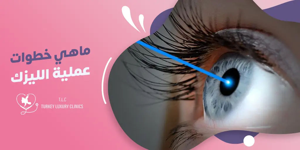 ماهي خطوات عملية الليزك؟