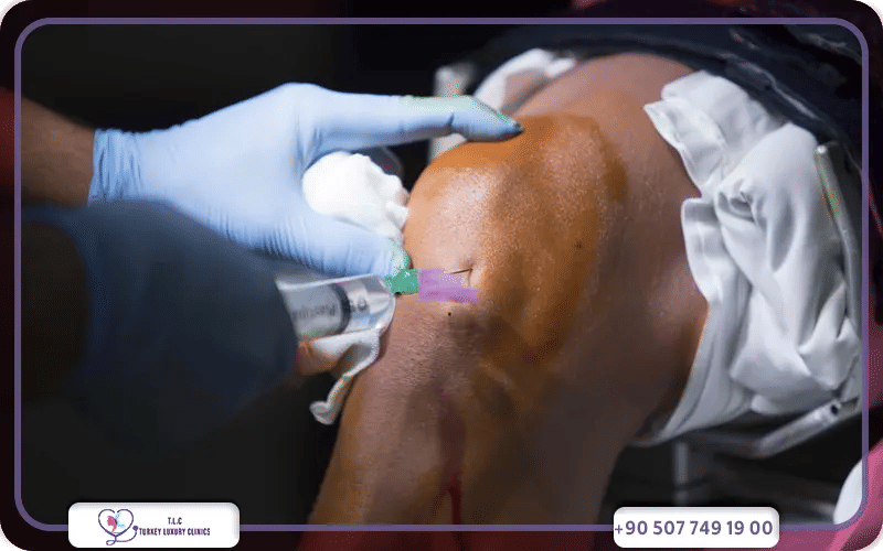 Hydrogel Injections for Knee Osteoarthritis