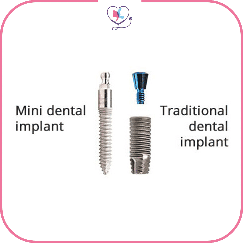 من هم المرشحون لزراعة الأسنان المصغرة؟