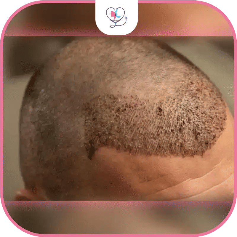 Hair Transplant for Receding Hairline