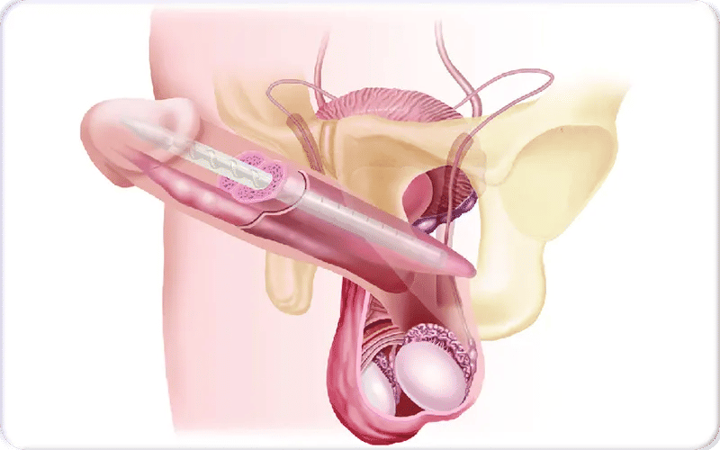 مميزات وعيوب الدعامة المرنة