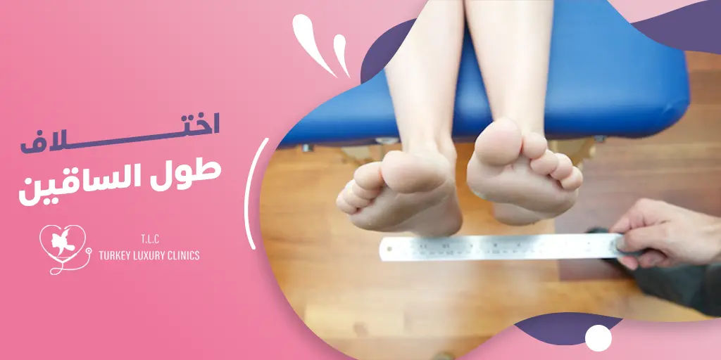 اختلاف طول الساقين: الأعراض والأسباب والعلاج