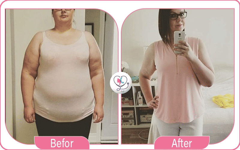 sleeve endoscopique avant après