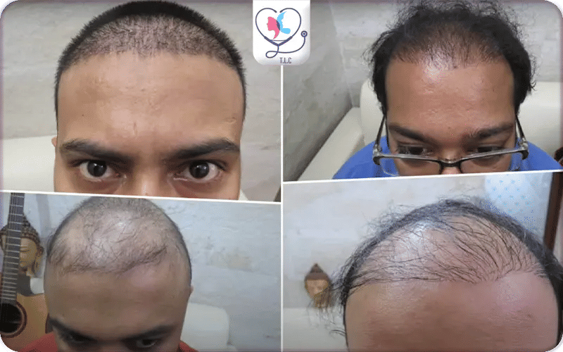 What Does “Hair Transplant Gone Wrong” Mean?