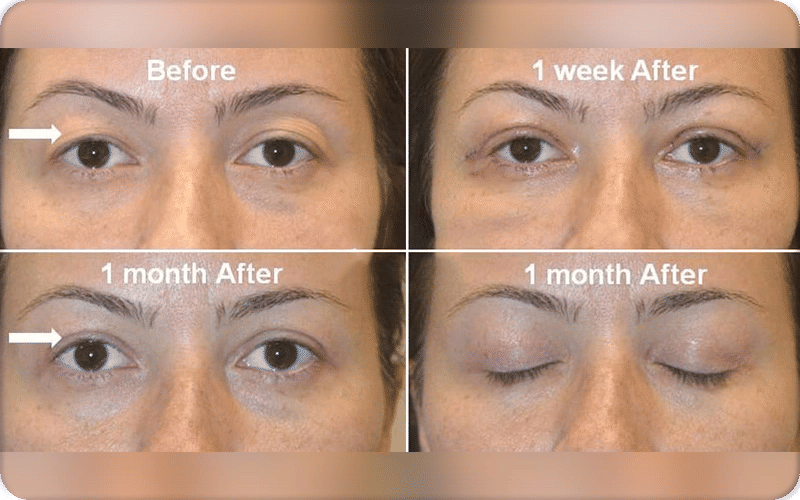 بعد أسبوعين من شد الجفون