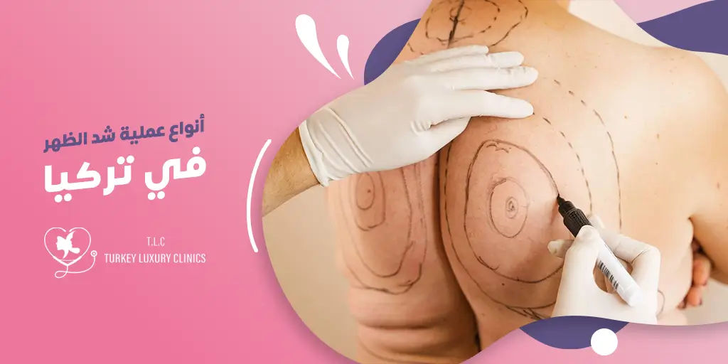 أنواع عملية شد الظهر في تركيا