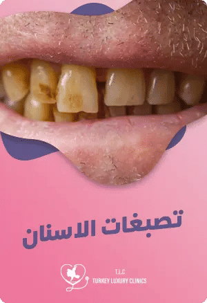 تصبغات الاسنان: الأسباب، العلاجات المنزلية والطبية الفعالةfeatured image