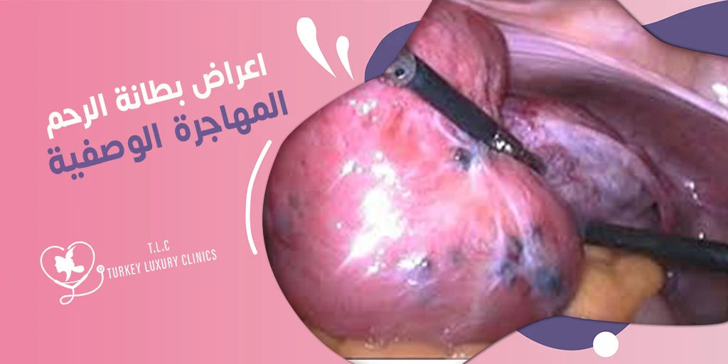 اعراض بطانة الرحم المهاجرة: كيف نساعدك بالعلاج والوقاية؟