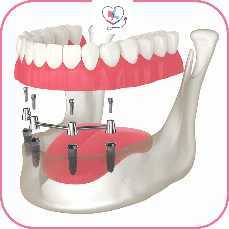 Incision et insertion des implants