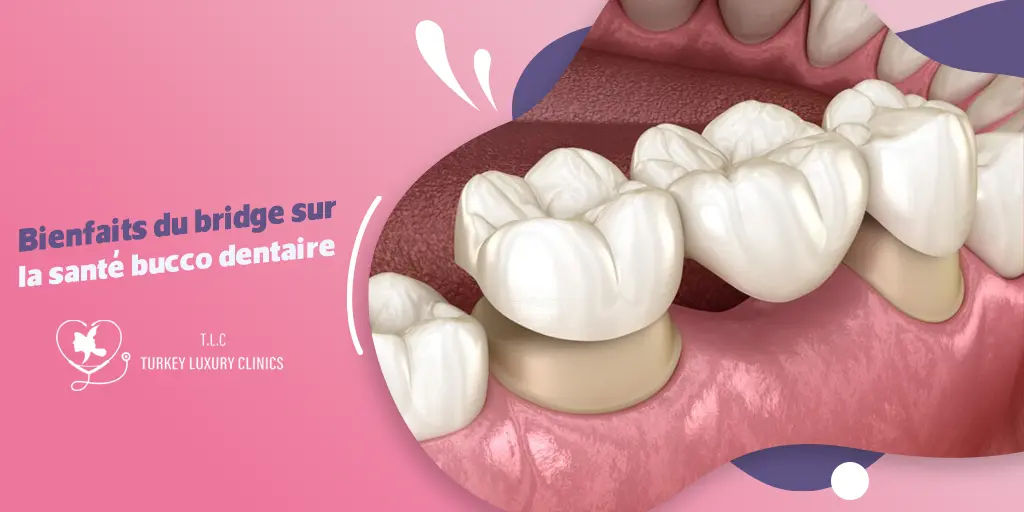 Bienfaits du bridge sur la santé bucco dentaire