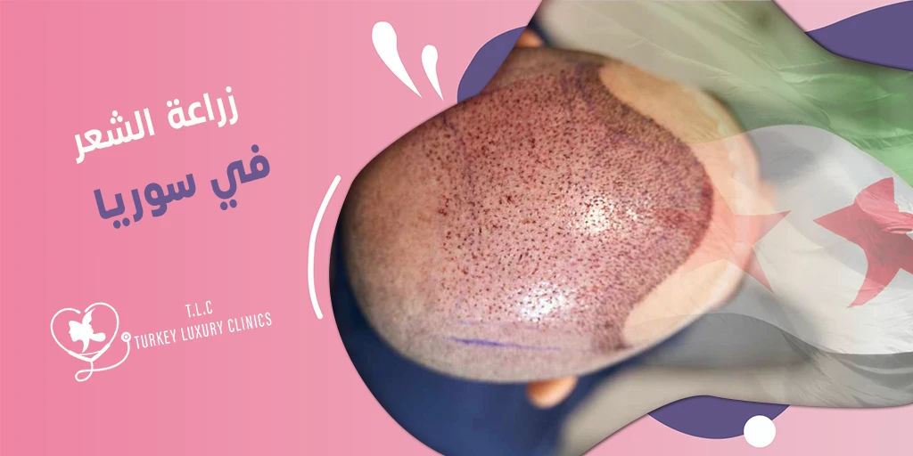 زراعة الشعر في سوريا: التقنيات ونسب النجاح و الأسعار 2026