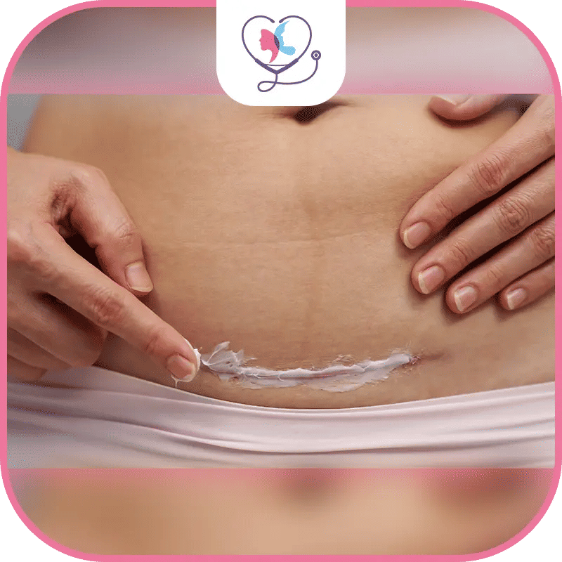 عملية شد البطن والحمل