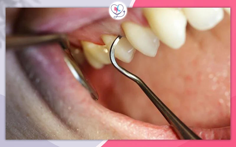 Why Smoking Affects Dental Implants