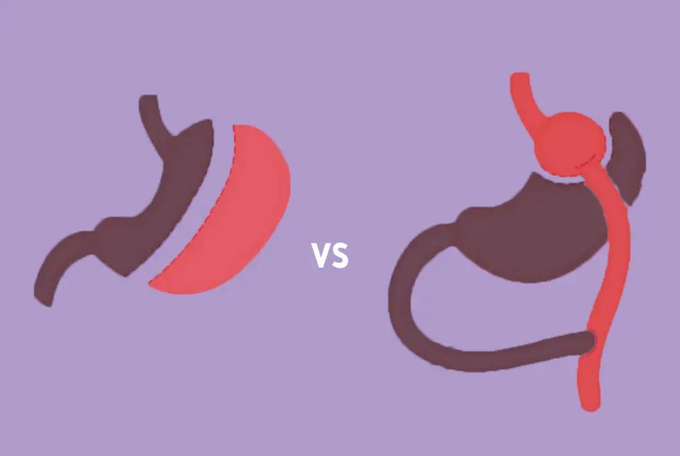Gastric Sleeve vs Gastric Bypass