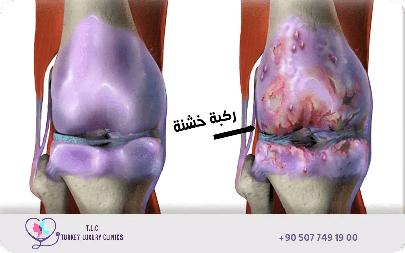 علاج خشونة الركبة تجربتي مع تركيا لاكشري كلينك علاج خشونة الركبة تجربتي مع تركيا لاكشري كلينك