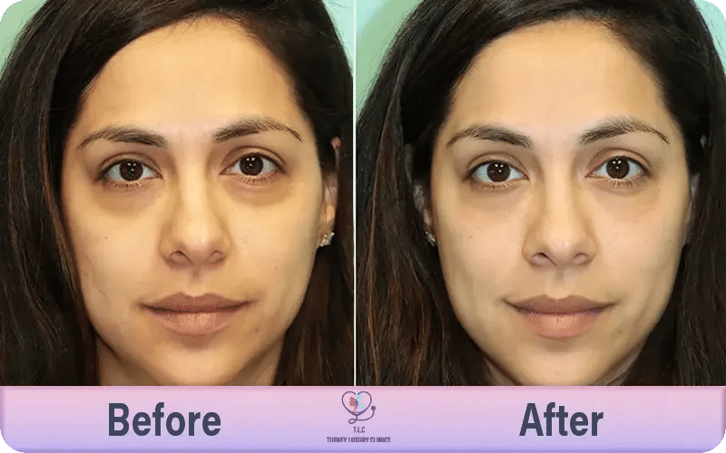 Results You Can Expect After Under Eye Filler