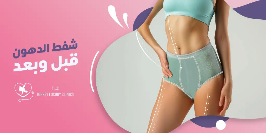 شفط الدهون قبل وبعد
