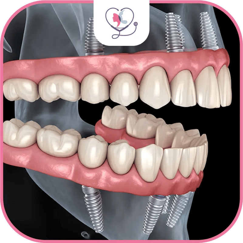 rehabilitation dentaire complete