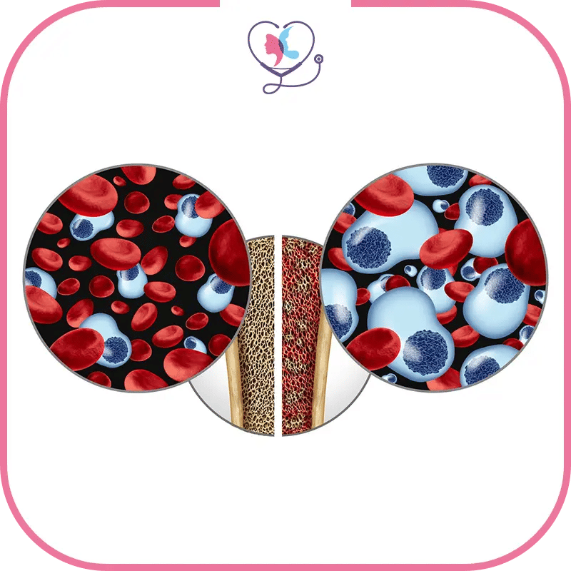 أنواع سرطان نخاع العظم